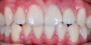 Upper front teeth after delivery of custom dental crowns.