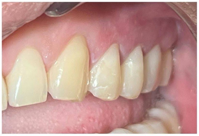 After Composite Filings