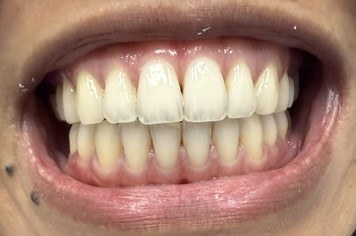 Smile before clear-aligner treatment showing uneven tooth alignment.