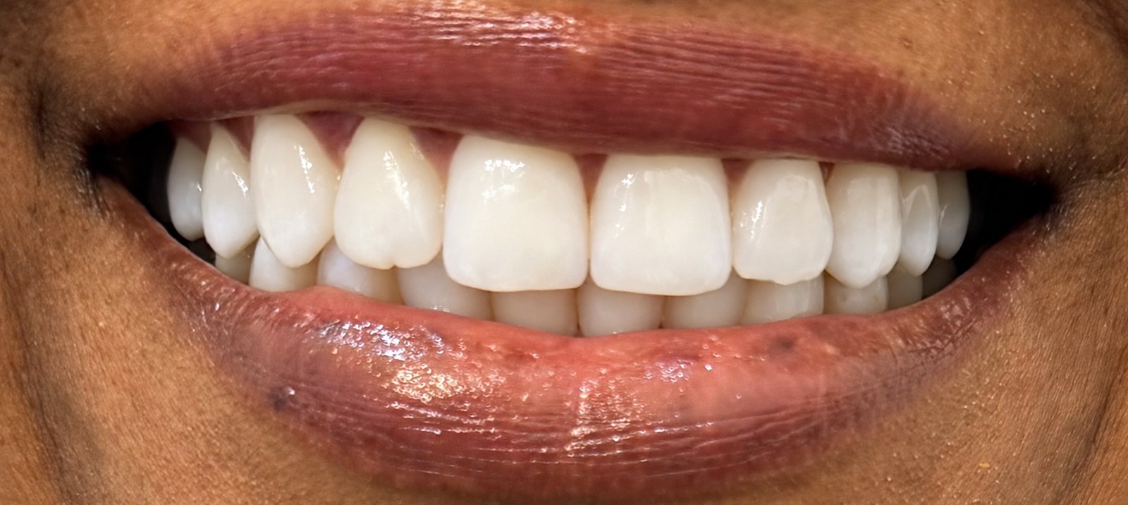Brighter smile after professional teeth-whitening treatment.